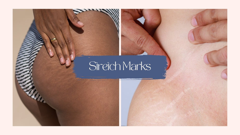 At home treatments for stretch marks - SkinBay