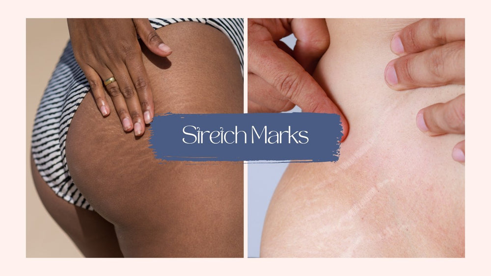 Microneedling for Stretch Marks - SkinBay Microneedling for Stretch Marks - SkinBay