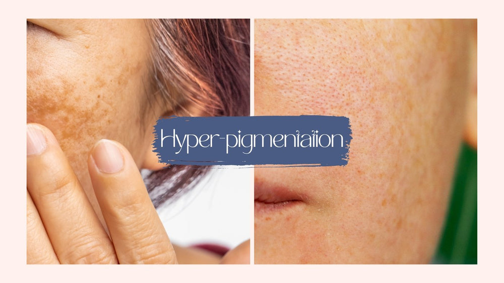 Top 5 Products for Fighting Pigmentation - SkinBay