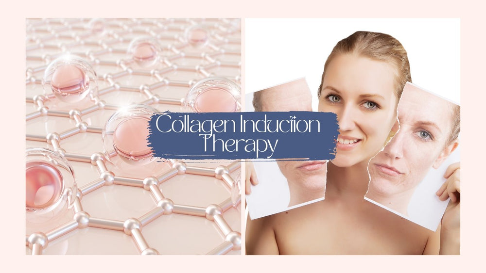 What is Collagen Induction Therapy? A Comprehensive Overview - SkinBay